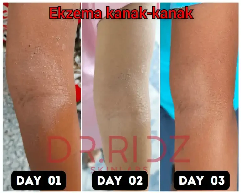 ⭐⭐⭐⭐⭐Qaseh masih di sek rendah ni pengidap eczema jenis Atopik Dermatatis (AD). Kalau dia aktif je berpeluh2 dekat sek, mula la flare datang balik, habis menggerutu & gatal-gatal kulit.   Selepas gunakan DERMCARE, alhamdullillah gatal-gatal hilang dalam masa 3 hari je, kulit kembali pun dah kembali normal dah tak menggaru
