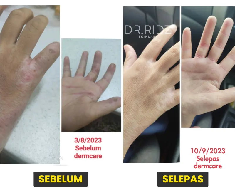 Belakang & Tapak Tangan