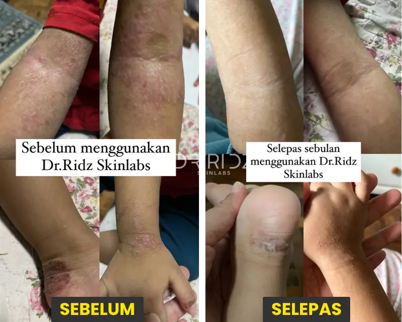 Pelipat Siku/Lutut