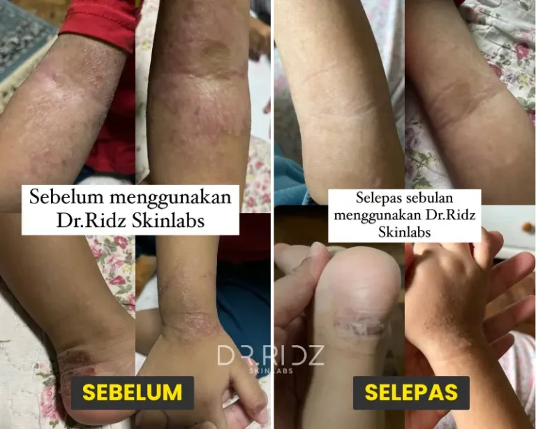 ⭐⭐⭐⭐⭐Kerap berlaku di bahagian pelipat tangan & kaki. Setiap kali flare, mmg tak tahan gatal rasa nak menggaru sampai berdarah. Kes ni agak serius, perlukan hampir sebulan untuk kulit kembali normal. Tapi lepas dah baik, dah jarang sangat flare balik sbb dah stop guna steroid. 