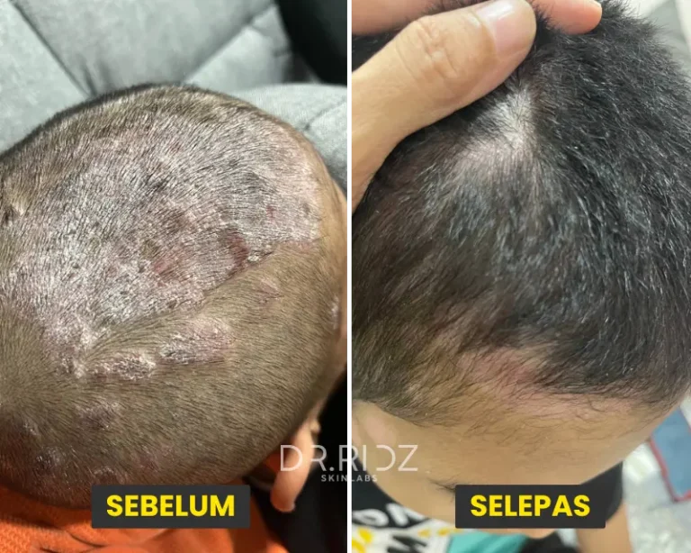 KERAK KEPALA