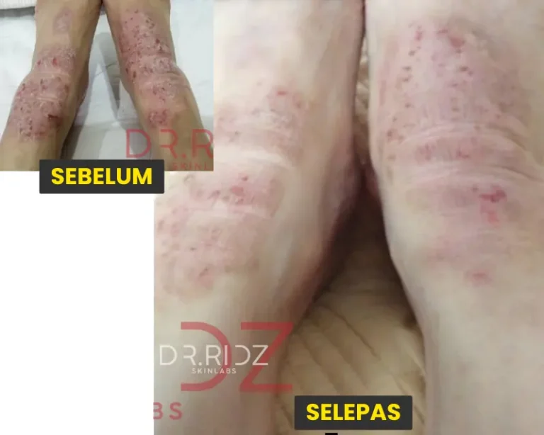 ⭐⭐⭐⭐⭐Pn Ruhani pengidap eczema kronik jenis Dyshidrotic Eczema. Kaki dia bila flare, jadi melepuh kulit, gatal yang amat sangat. Memang habis luka-luka berdarah bila garu.  Selepas gunakan DERMCARE, alhamdullillah gatal-gatal hilang. Dalam beberapa hari, kulit yang melepuh tu pun dah kering, gatal-gatal pun dah tak ada.