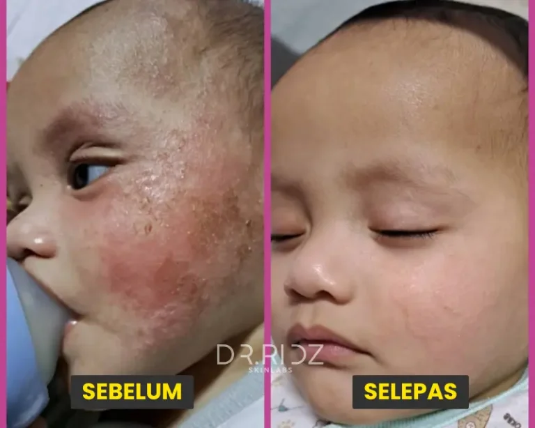 CONTACT ECZEMA