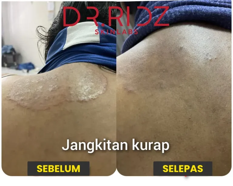 JANGKITAN KURAP