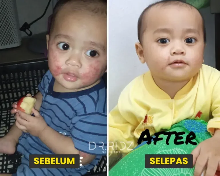 RUAM ALERGIC