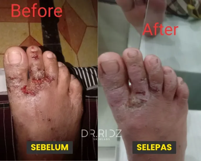GATAL ECZEMA