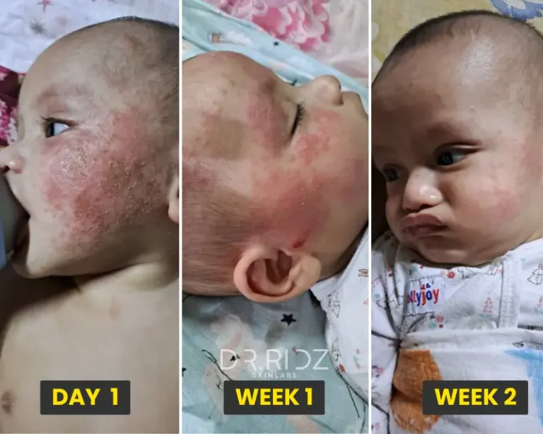 ECZEMA MUKA