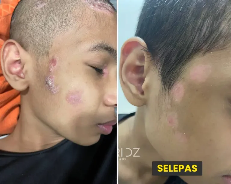 ⭐⭐⭐⭐⭐Ini anak Pn.Rosma yang mengalami gatal-gatal kulit kepala sampai terpaksa gunting botak. Kulit kepala gatal & berkerak. Kesian, nak pergi sekolah pun susah...  Selepas gunakan DERMCARE, alhamdullillah gatal-gatal akhirnya hilang. Lepas consistent guna kuping-kuping dikepala mula hilang, kulit kembali normal dah tak menggaru. Rambut pun dah boleh simpan panjang balik.