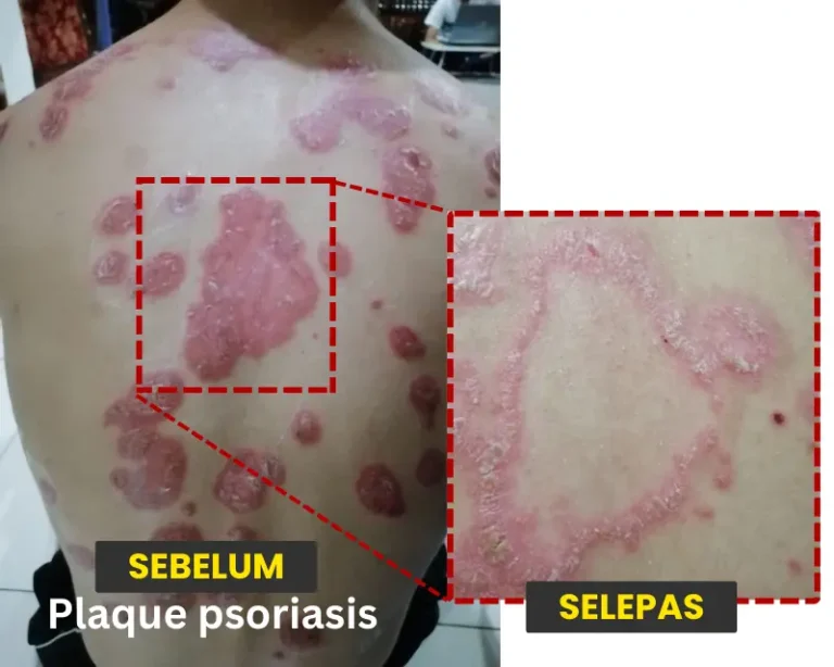 PSORIASIS